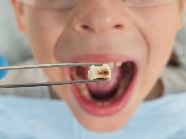Best Broken or Cracked Tooth Emergency Dentist in Fairview Heights, IL